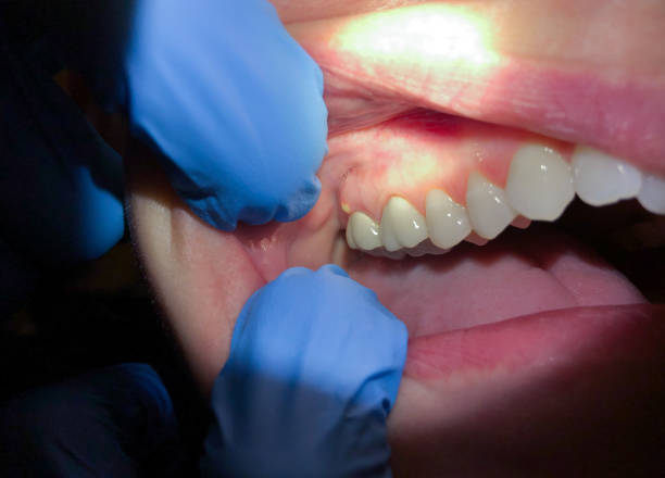 Best Emergency Dental Care for Abscessed Tooth in Oblong, IL